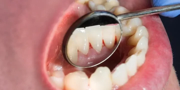 Chảy máu chân răng do đâu? Nguyên nhân và cách khắc phục hiệu quả